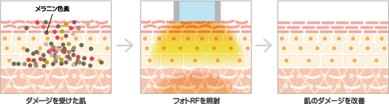 ダメージを受けた肌も改善されます